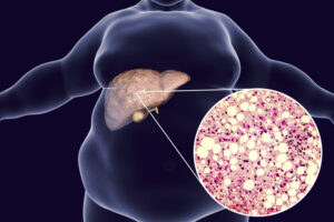 Eating Your Way to Liver Health:                           Plant-Based Diet Can Shield You from Fatty Liver Disease